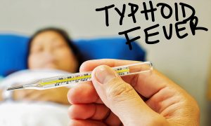 typhoid fever