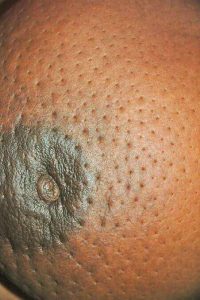 Peau d'orange, one of the late signs of breast cancer